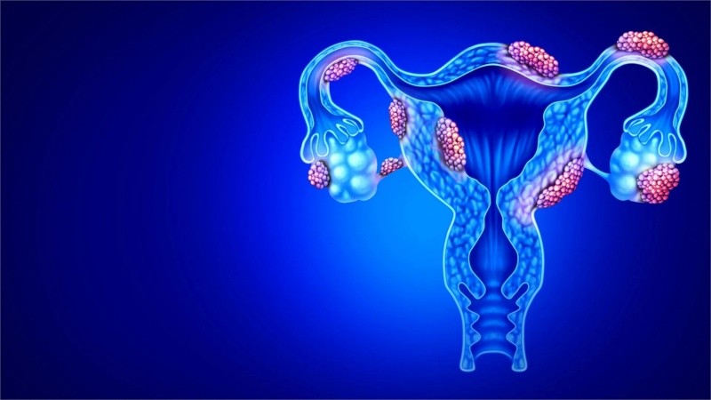 Esta patología conlleva padecer inflamación y formación de tejido cicatrizal en la región pélvica u otras zonas.