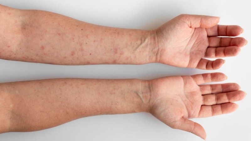 Desde el organismo recomiendan mayor concientización y mejoras en la posibilidad de llegar a diagnósticos tempranos.