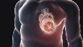 Quienes sobreviven a un infarto agudo de miocardio tienen mayor riesgo de volver a sufrir un evento cardiovascular durante el primer año posterior al hecho.