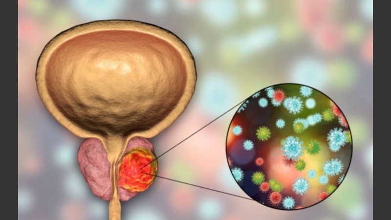 El diagnóstico precoz implica detectar a tiempo un tumor, previo a que se manifiesten síntomas.