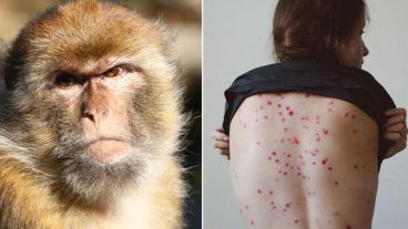 La viruela del mono es una rara enfermedad, menos severa que la viruela, que causa picazón que se extiende por el cuerpo, fiebre, escalofríos y dolores, entre otros síntomas.