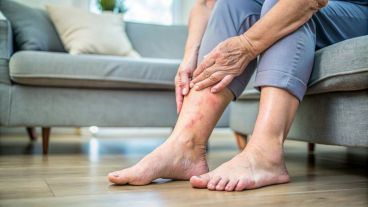 A nivel mundial, Brasil se une a otros 19 países y territorios del mundo que han sido validados por la OMS por haber eliminado la filariasis linfática como problema de salud pública.