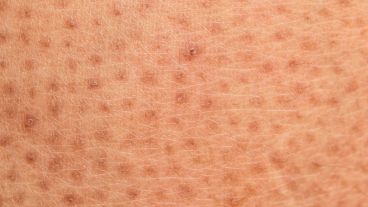 En ocasiones, también puede afectar a órganos internos.