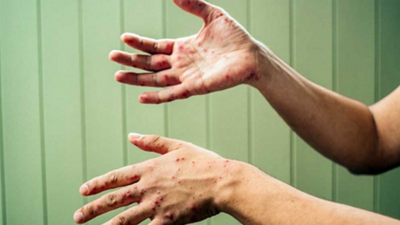 La vacuna contra el sarampión está en calendario al año de vida y al ingreso escolar.