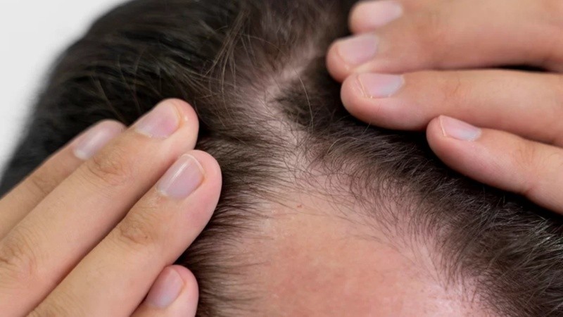 Afecta al 80% de hombres a lo largo de su vida y al 40% de mujeres que no alcanzaron los 50 años.