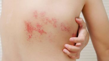 Afecta al menos al 20% de la población y hasta al 50% de adultos mayores de 85 años.