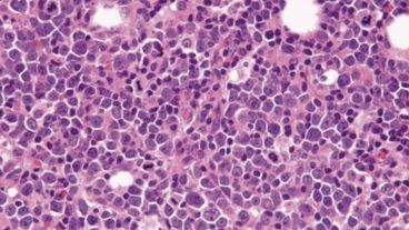 Tiene mayor frecuencia en varones mayores de 60 años y se caracteriza por una alteración genética específica.