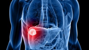 Se estima que en Argentina cerca de 300 mil personas tienen hepatitis B o C, pero la enorme mayoría de ellas no lo sabe.