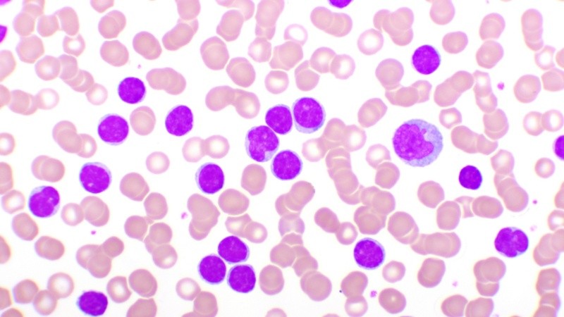 Se estima que en Argentina representa entre un 25 y un 30% de las leucemias diagnosticadas en adultos, lo que la convierte en la más frecuente en esa población.