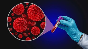 Se trata de un tipo de cáncer hematológico que se origina en las células plasmáticas.