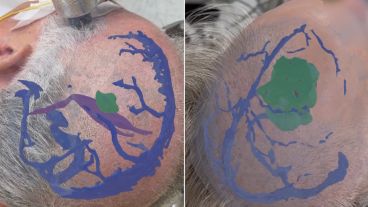 Así ven los médicos la cabeza de los pacientes antes de ser operados.