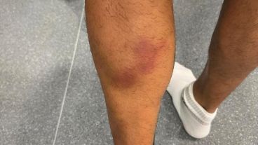 Dibu mostró la secuelas de su desgarro, que no lo detiene.