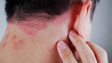 Suele vincularse a múltiples comorbilidades como artritis psoriásica, enfermedad cardiovascular, obesidad, depresión y diabetes, mientras que no reconoce diferencias de género y puede presentarse a cualquier edad.