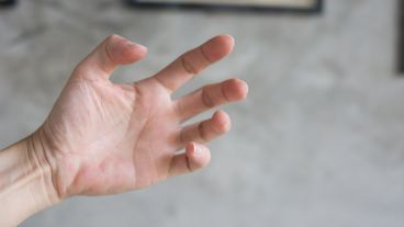 Un trastorno motor que aparece como consecuencia de una lesión en el sistema nervioso central.