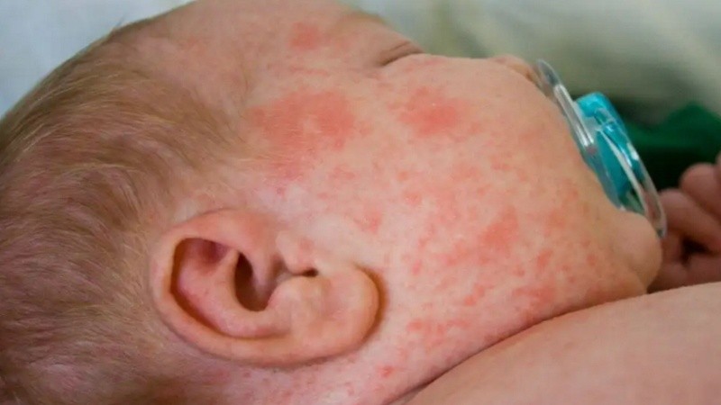 El sarampión es una enfermedad viral altamente contagiosa.