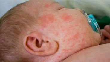 El sarampión es una enfermedad viral altamente contagiosa.