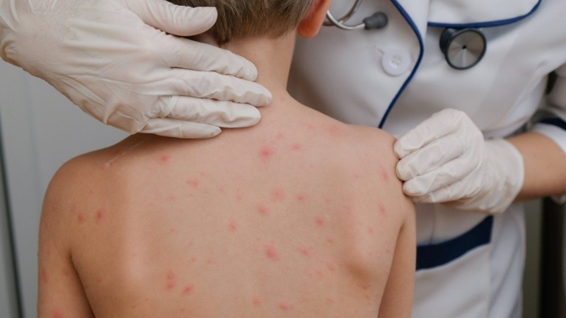 La transmisión afectó principalmente a comunidades con baja cobertura de vacunación.