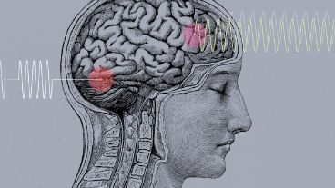 La aplicación de ultrasonidos podría ayudar a eliminar células muertas tras un ictus cerebral.