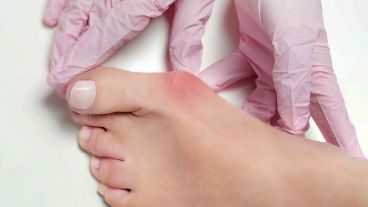 Existe una predisposición genética de tipo familiar, con una afectación mucho más frecuente en las mujeres que en los hombres.