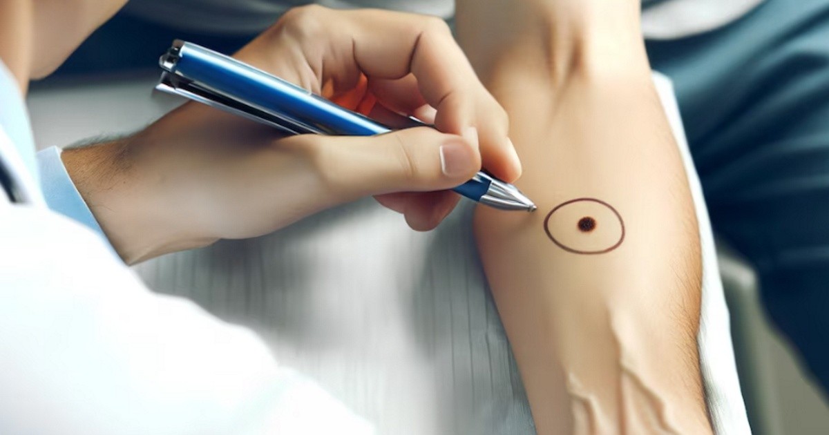 Argentine Vaccine Fights Aggressive Skin Cancer | Melanoma