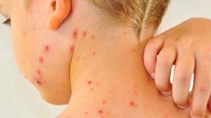 Los nuevos casos corresponden a una familia uruguaya sin antecedentes de vacunación.