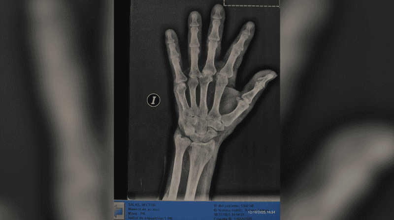 La familia denunció que el hombre sufrió una fractura en el dedo pulgar.&nbsp;