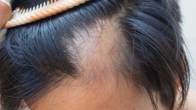 El cabello puede perderse lenta o rápidamente y su crecimiento eventual dependerá de la causa de la caída.