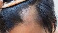El cabello puede perderse lenta o rápidamente y su crecimiento eventual dependerá de la causa de la caída.