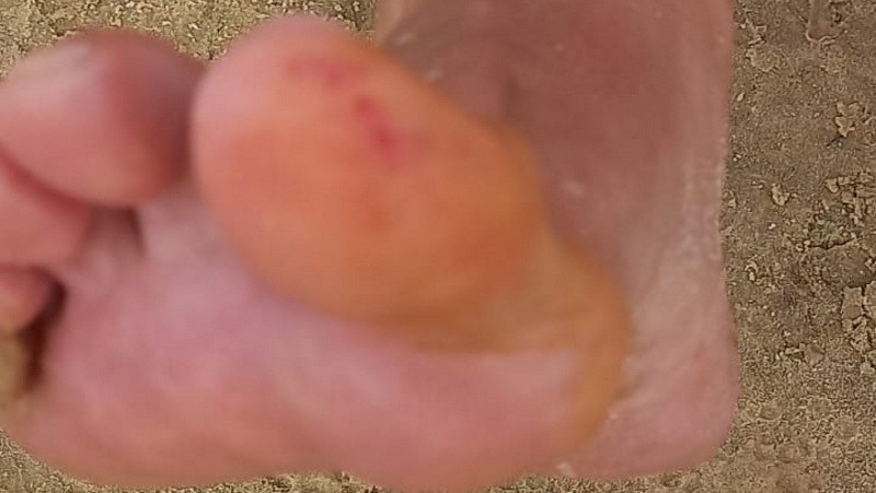 &nbsp;Una de los peces le atacó un pie.