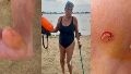 Andrea fue mordida en las piernas por palometas mientras nadaba en La Florida.