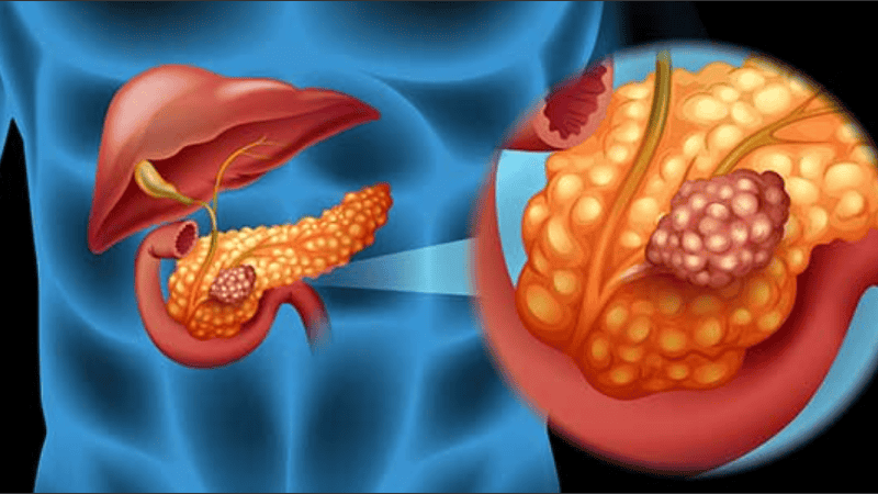 Consiguieron la regresión completa del adenocarcinoma ductal mediante una triple terapia.