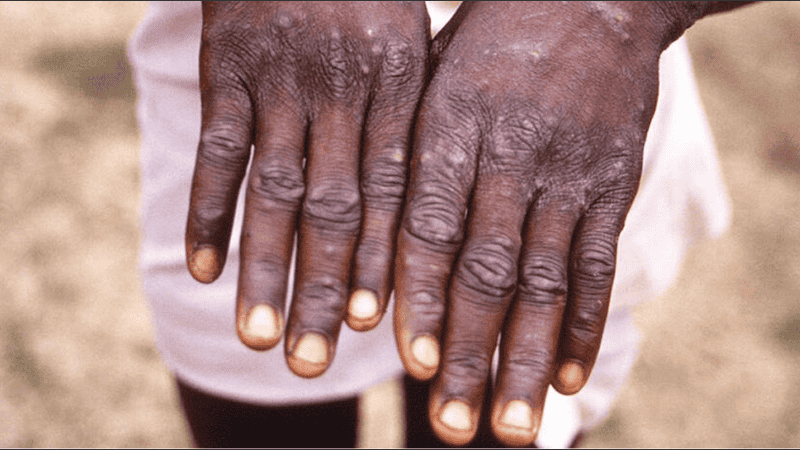 Primer caso de la variante más severa de Mpox en Argentina.