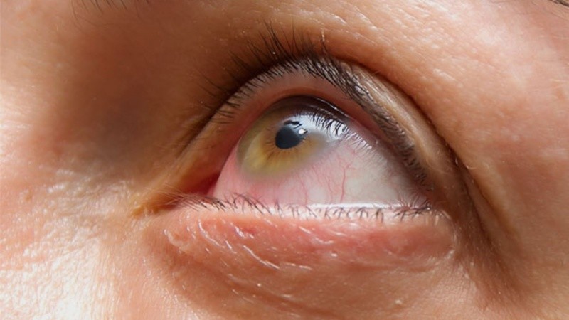 Según datos internacionales del Grupo Europeo sobre orbitopatía de Graves (EUGOGO), entre el 25% y el 50% de los pacientes con esta enfermedad desarrollará algún grado de compromiso ocular.