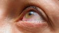 Según datos internacionales del Grupo Europeo sobre orbitopatía de Graves (EUGOGO), entre el 25% y el 50% de los pacientes con esta enfermedad desarrollará algún grado de compromiso ocular.