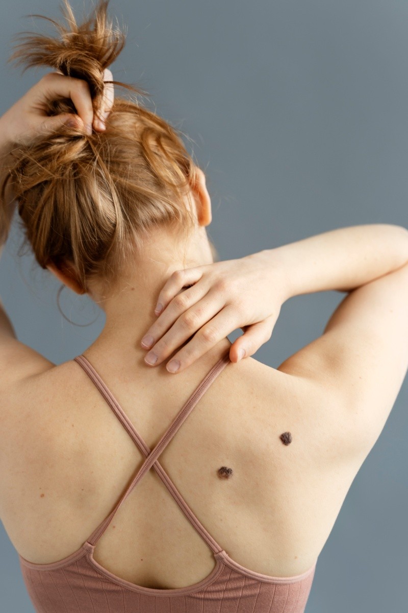 Claves para la prevención del cáncer de piel&nbsp;
