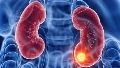 En Argentina es el quinto cáncer más frecuente y representa casi el 4% de los diagnósticos oncológicos.