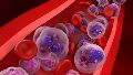Los investigadores descubrieron el papel del factor de transcripción IRF2 en el desarrollo de este tipo de cáncer.