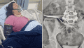 Después de una cirugía en Brasil, una mujer de 35 años vivió tres meses con una tijera adentro.