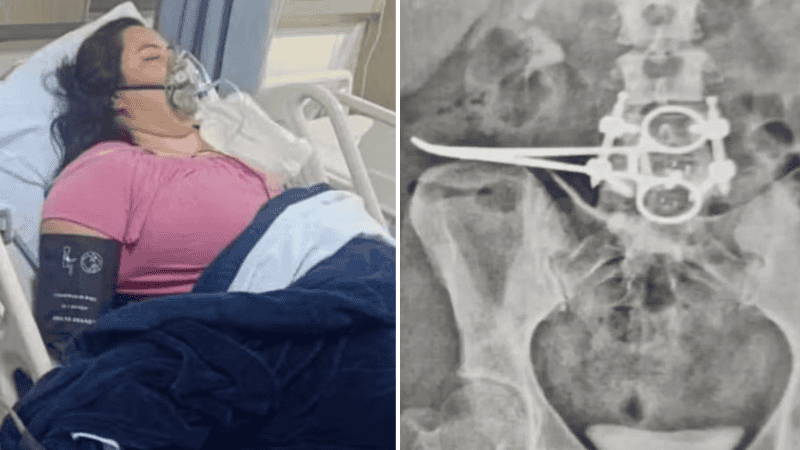 Después de una cirugía en Brasil, una mujer de 35 años vivió tres meses con una tijera adentro.