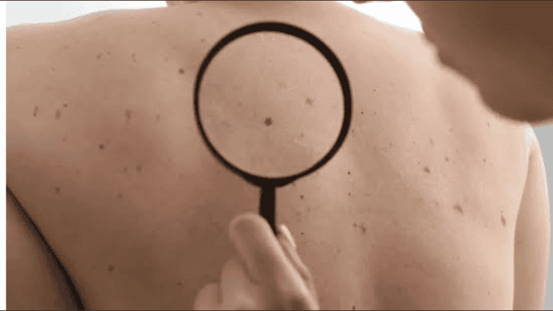 l tratamiento de Moderna y Merck redujo el riesgo de recaída y de metástasis del melanoma al combinarse con el medicamento de inmunoterapia Keytruda.