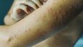 La varicela es una infección altamente contagiosa causada por el virus varicela-zóster. Generalmente se presenta en la niñez y, aunque molesta, suele ser leve. El problema aparece cuando llega en la adultez.