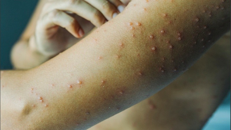 La varicela es una infección altamente contagiosa causada por el virus varicela-zóster. Generalmente se presenta en la niñez y, aunque molesta, suele ser leve. El problema aparece cuando llega en la adultez.