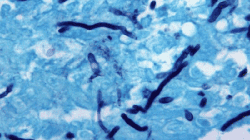 De los 49 casos totales, el 88% fueron detectados en tejido cerebral intracraneal y el 12% en muestras pulmonares.
