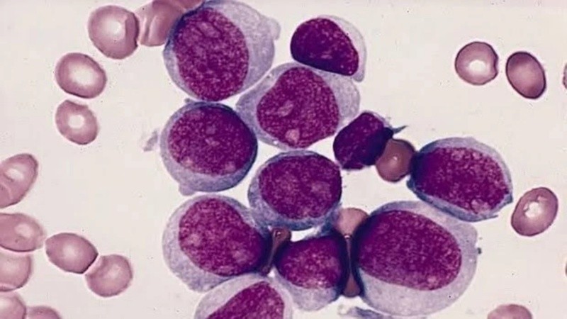 El estudio identificó un grupo de genes cuya actividad conjunta permitiría mejorar las predicciones sobre la evolución de este tipo de cáncer de la sangre y la respuesta a los tratamientos.
