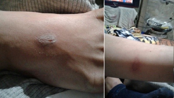 Lesiones en pie y pierna de uno de los adolescentes internado en San Camilo.