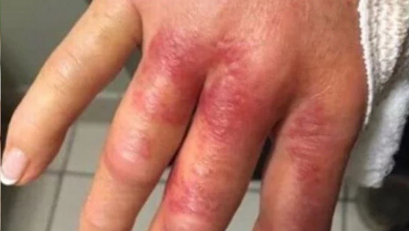 Casi pierde uno de sus dedos por una bacteria.