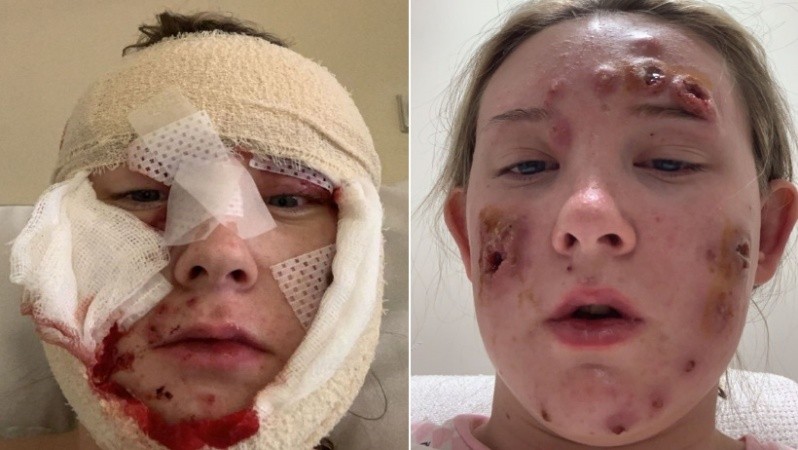 La joven se encuentra en recuperación.