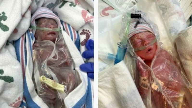 Después de varias semanas la bebé logró salir de terapia.