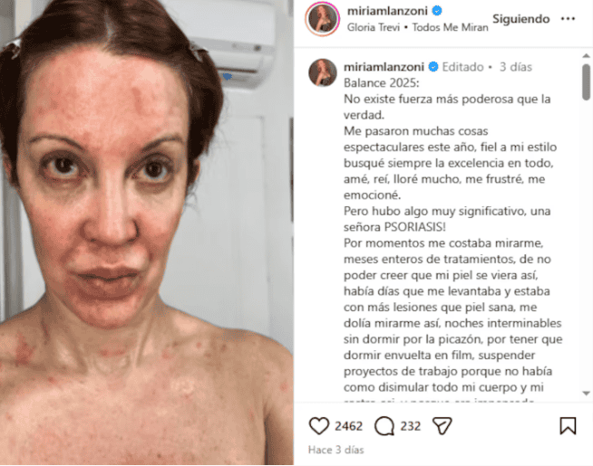 &nbsp;Lanzoni compartió fotos de ella envuelta en plástico por la enfermedad.